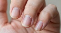 causes of nail peeling