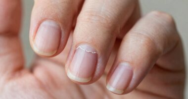 causes of nail peeling