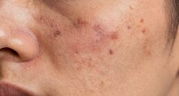 different skin discoloration treatments