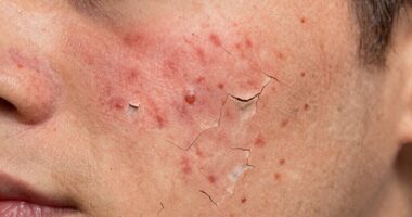 dry skin causing breakouts