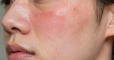 habits causing persistent redness