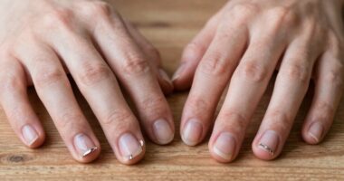 lifestyle factors causing peeling