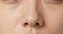 nose foundation separation pattern