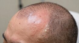 post transplant hair care