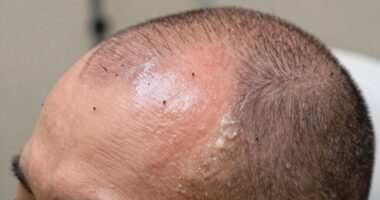 post transplant hair care