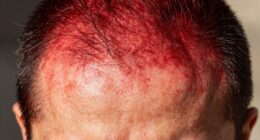 protect your sunburned scalp