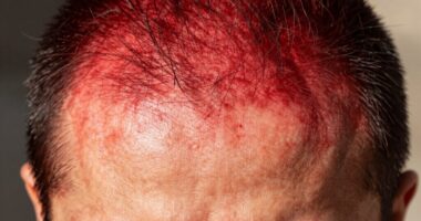 protect your sunburned scalp