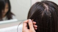 seasonal hair shedding concerns