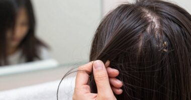 seasonal hair shedding concerns