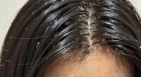 clogged follicles dull appearance