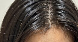 clogged follicles dull appearance