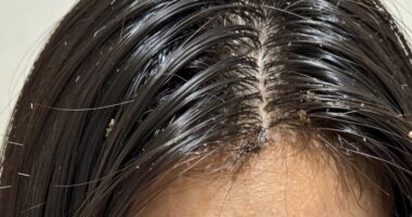 clogged follicles dull appearance