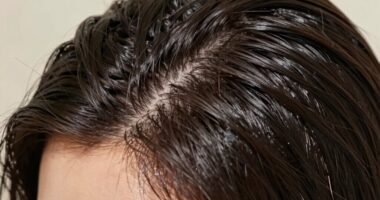 overproduction of scalp oil