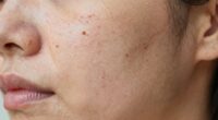 skin dullness from over exfoliation