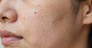 skin dullness from over exfoliation