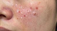 sudden breakout and redness