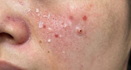 sudden breakout and redness