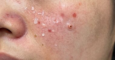 sudden breakout and redness